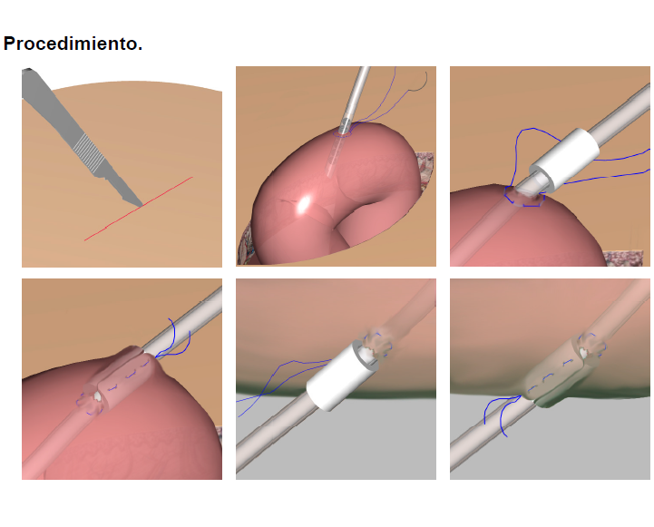 Sonda Yeyunostomía 8Fr de Silicona